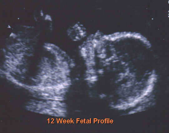 Accuracy of dating scan at 5 weeks